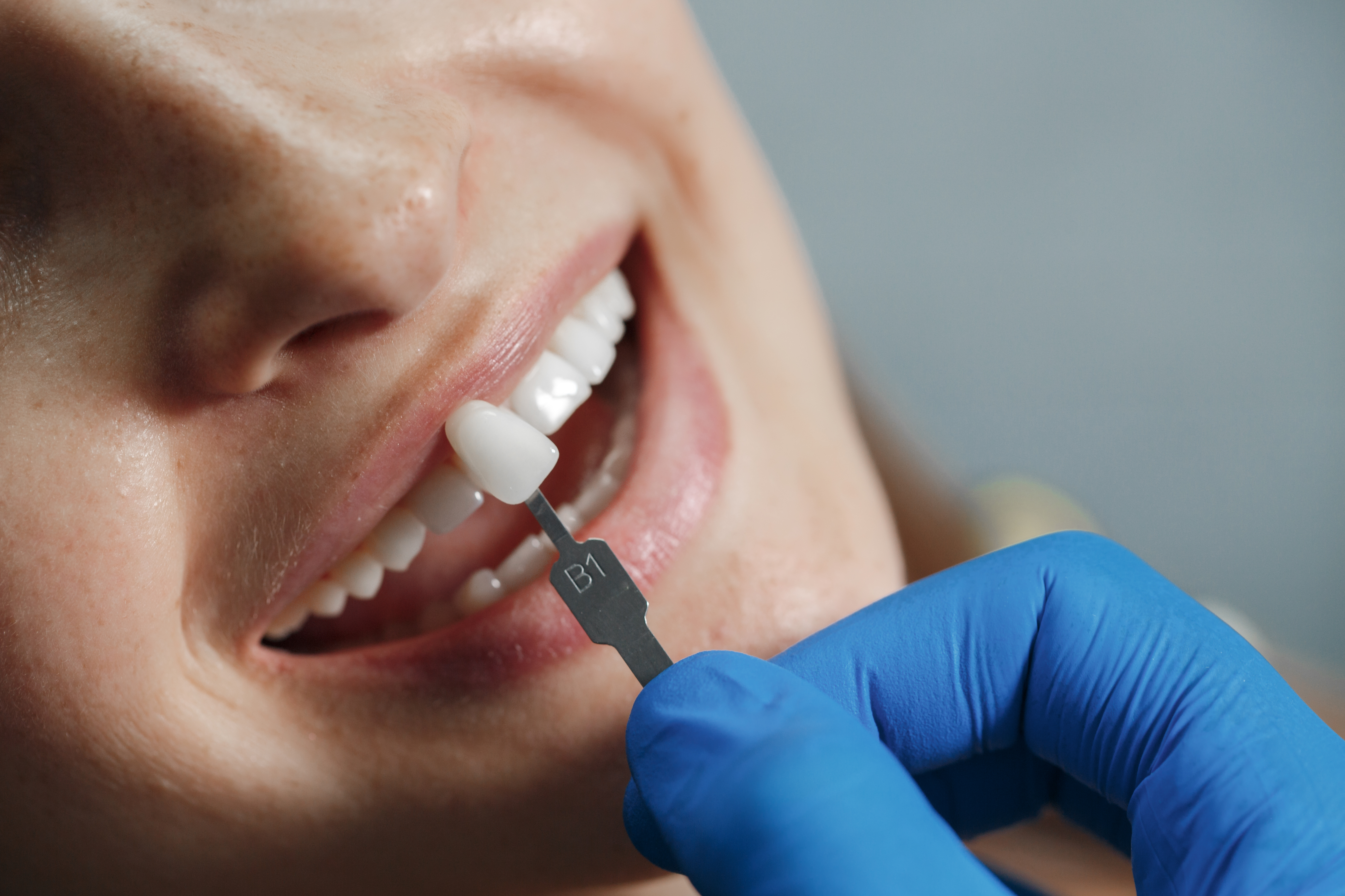 Orthodontic Braces